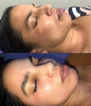 Peeling clareador de manchas