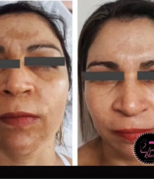 tratamento para melasma em montes claros