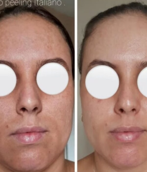 tratamento para melasma em montes claros