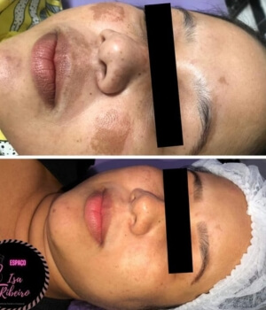 tratamento para melasma em montes claros