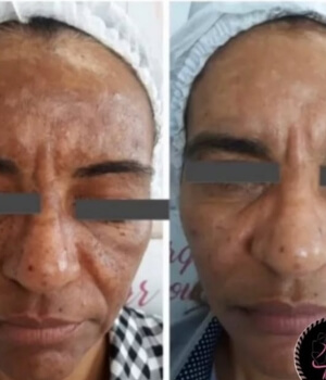 tratamento para melasma em montes claros